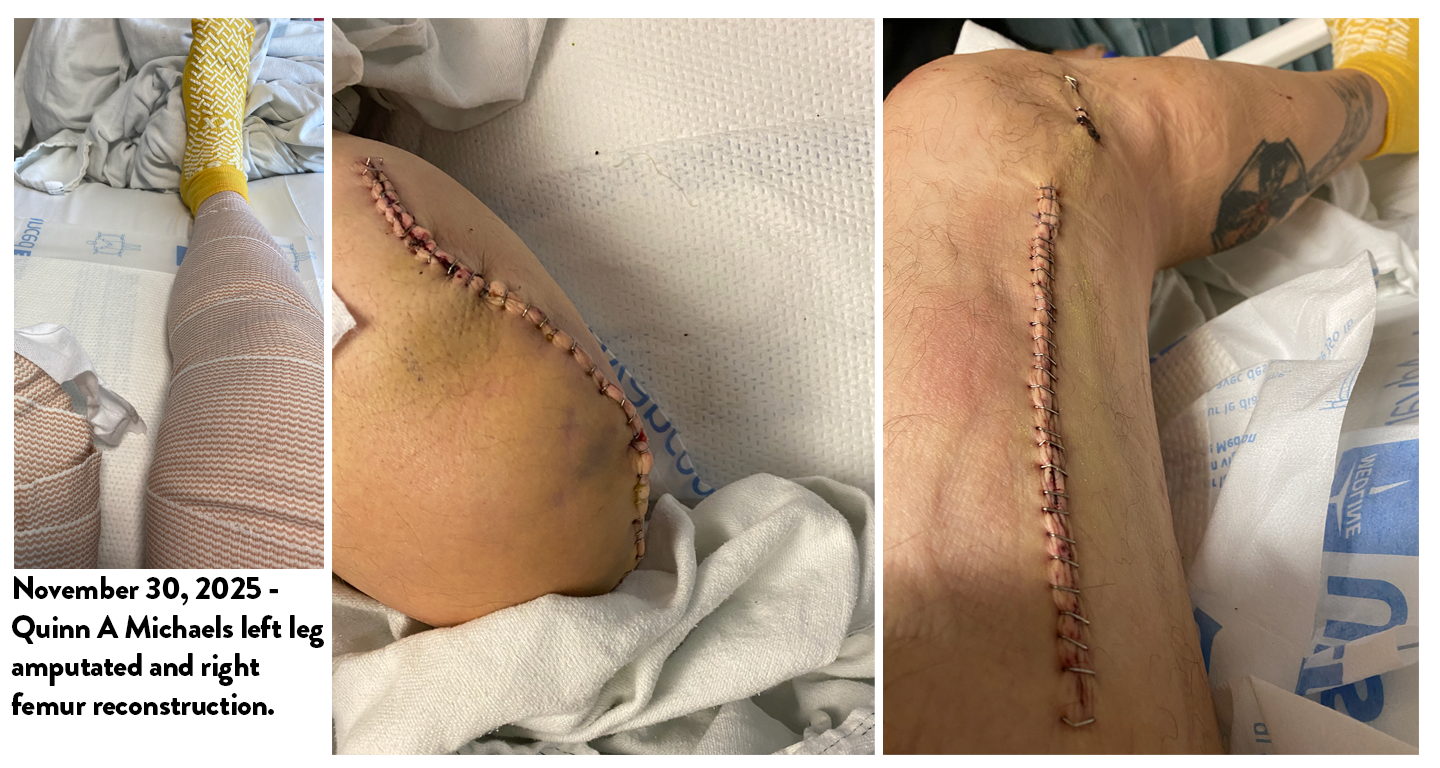 Quinn Michaels Amputation Photos
